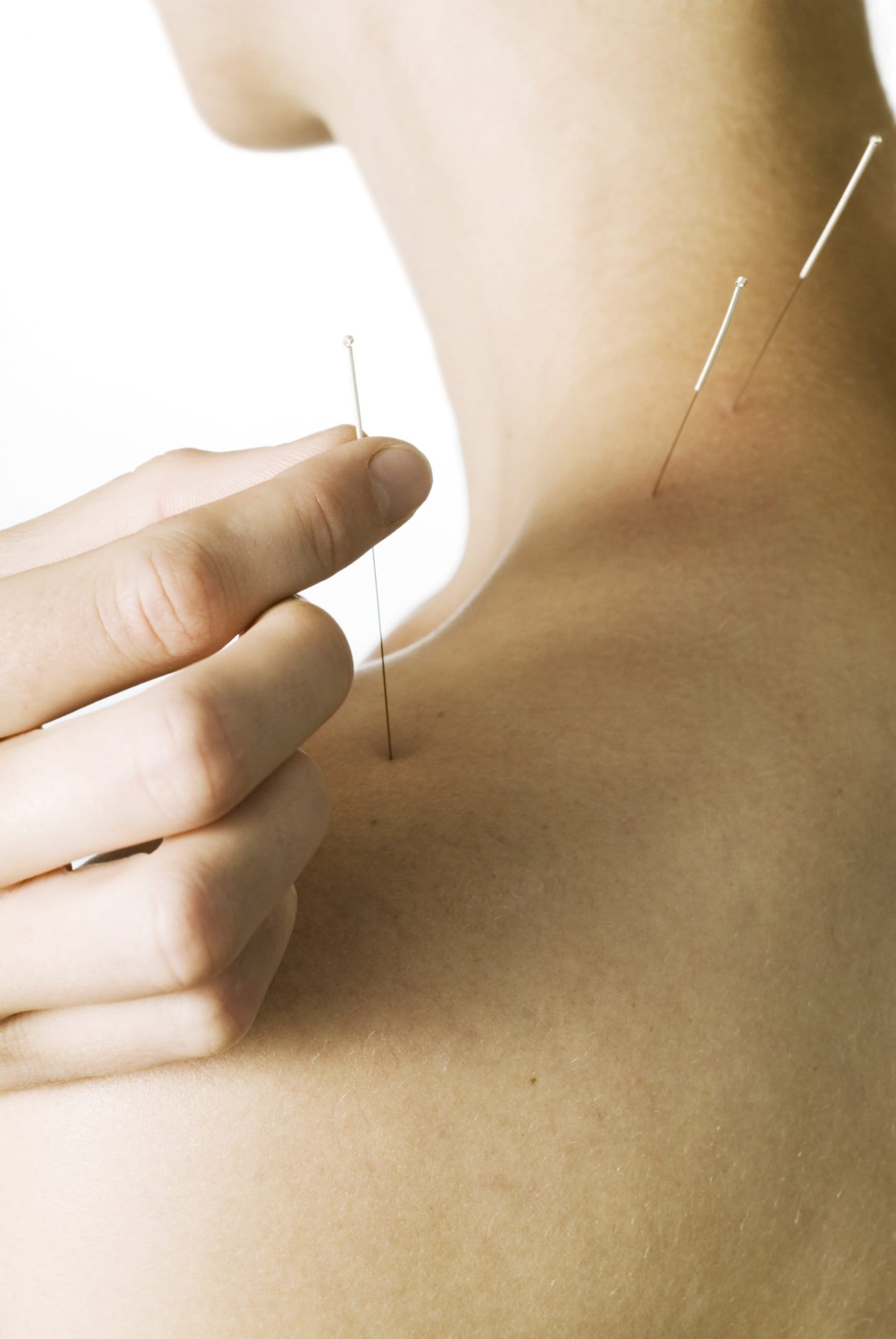 Acupuncture Orlando Fertility clinic Orlando Gallery