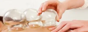 Cupping orlando acupuncture
